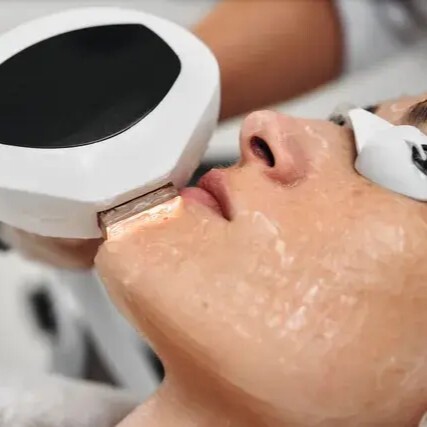 laser handpiece on a client's chin area, eyes protected, during a pigmentation treatment