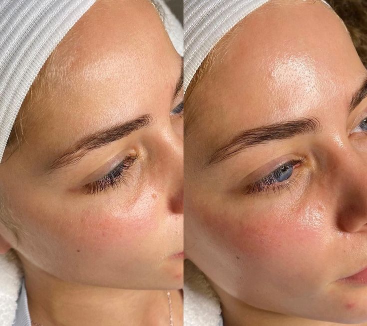 Vorher-Nachher der Wange mit frischem Glow - Ergebnis der JetPeel-Behandlung in Wien