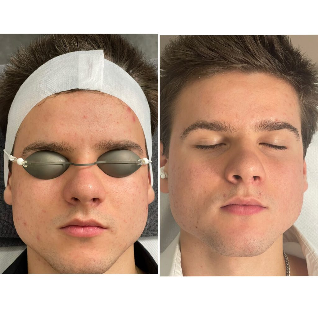 Junger Mann vorher und nachher mit klarerer Haut - Ergebnis der Männerkosmetik in Wien