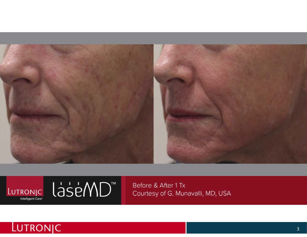 Laser Gesichtsbehandlung vorher nachher: links Falten und Pigment an der Wange, rechts glattere, ebenmäßigere Haut