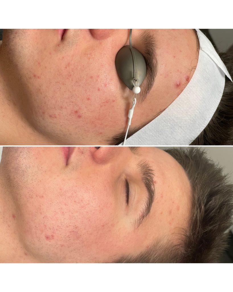Männerkosmetik Vorher Nachher: oben unreine, gerötete Männerhaut, unten ein ruhigeres, klareres Hautbild