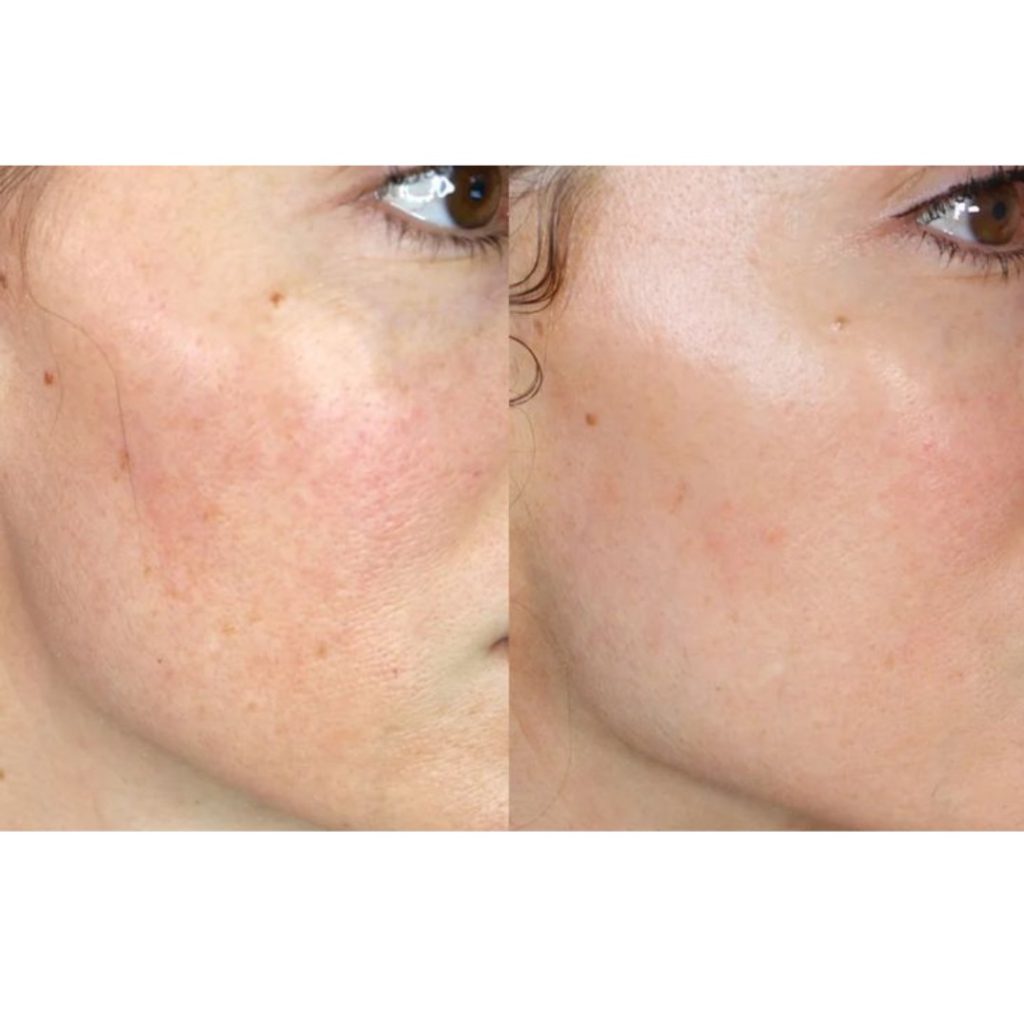 Vorher-Nachher der Wange mit ruhigerem Hautbild - Ergebnis von Microneedling in Wien