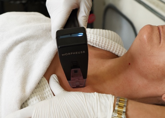 Morpheus8 anti-aging treatment on a client's neck at AFACIAL in Vienna