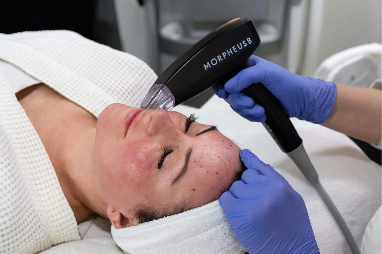 Morpheus8-Behandlung im Gesicht einer Kundin bei AFACIAL in Wien – Anti Aging mit Kollagenstimulation