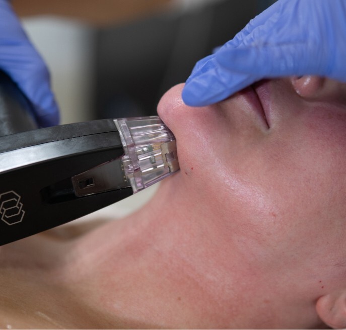 Needling-Handstück an der Kinnpartie während einer Microneedling-Behandlung in Wien