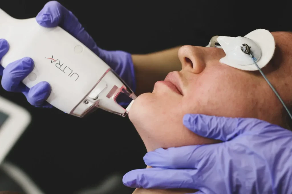 ULTRA-Laserhandstück am Gesicht mit Augenschutz - Thulium Laser Behandlung in Wien
