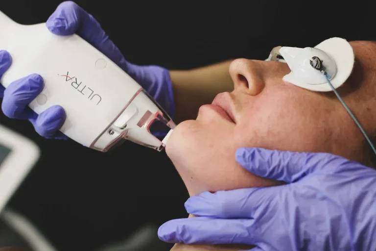 ULTRA-Laserhandstück am Gesicht mit Augenschutz - Thulium Laser Behandlung in Wien
