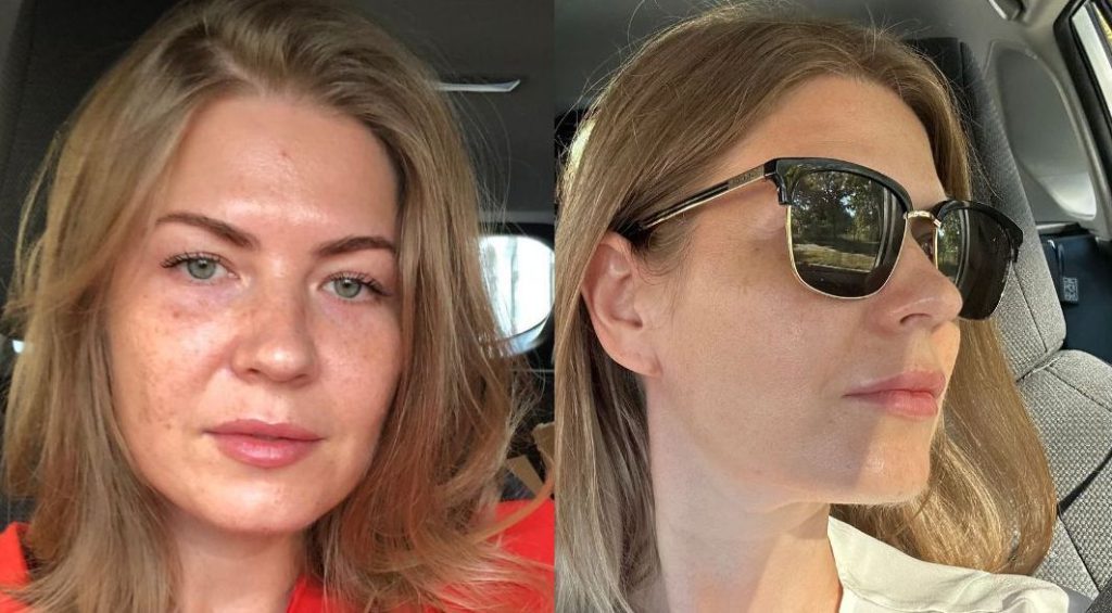 Vorher-Nachher-Selfies mit gleichmäßigerem Teint - Ergebnis der Pigmentbehandlung in Wien